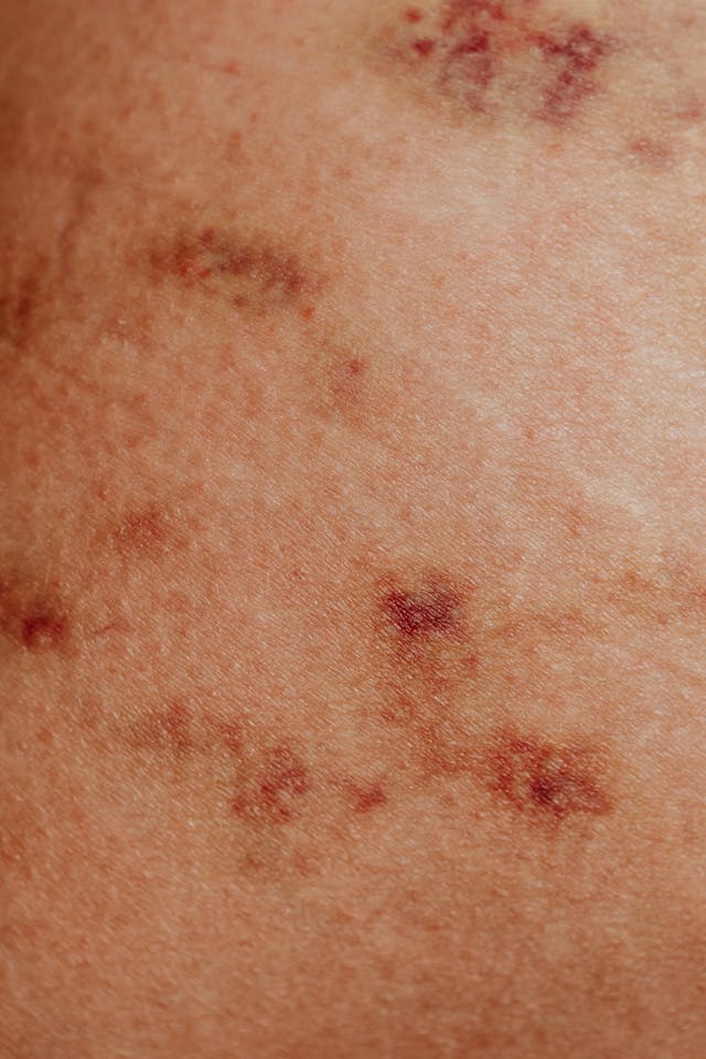 rashes due to bed bugs